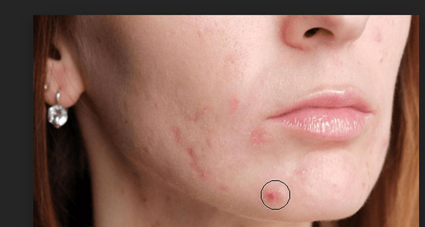 Click chuột vào mụn muốn xóa