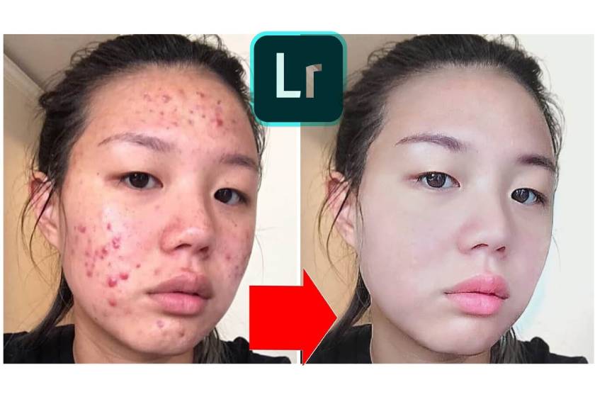 Xoá mụn bằng Lightroom 2020